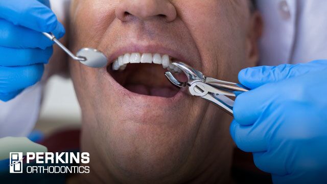 tooth extractions during orthodontics are not unheard of.